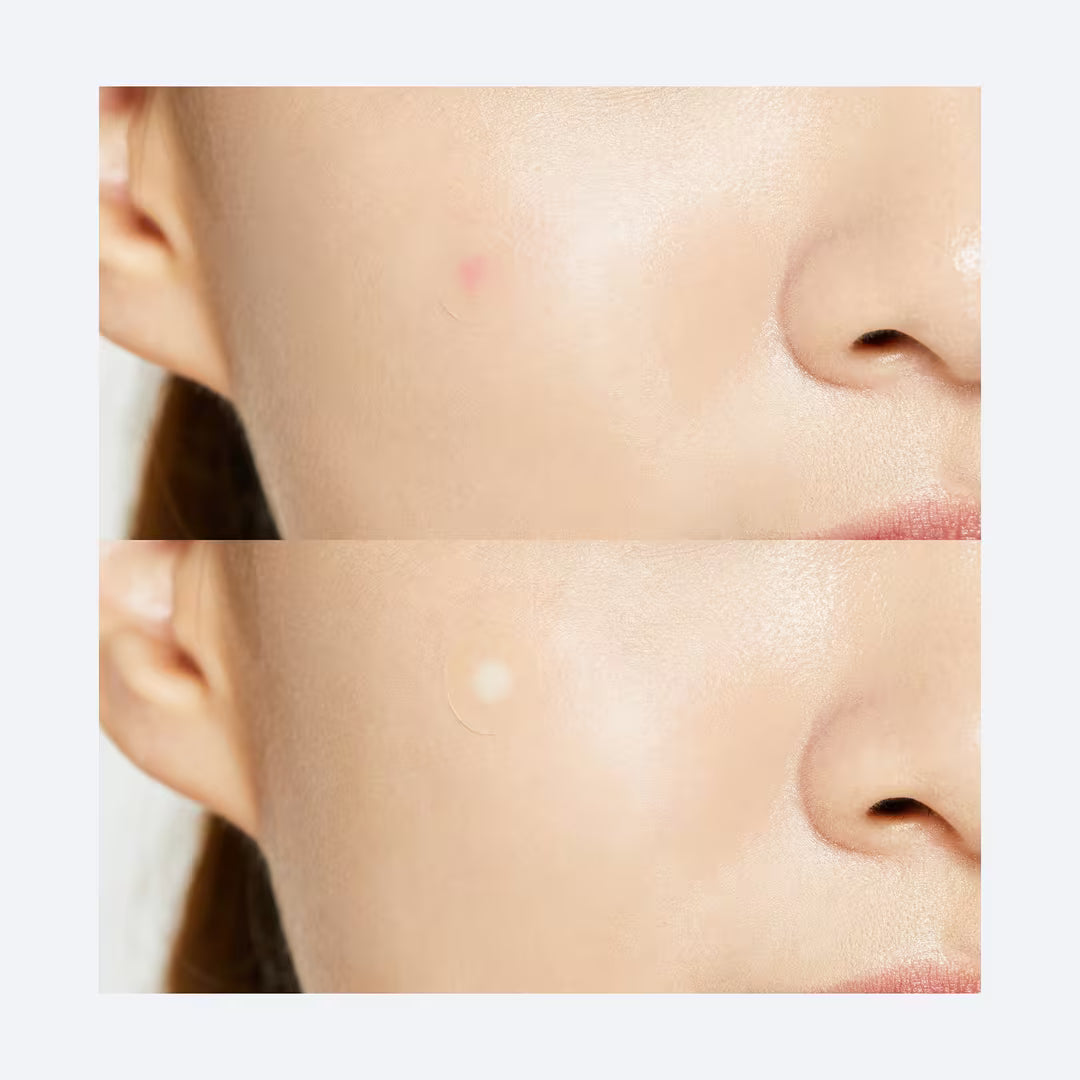 COSRX - Acne Pimple Master Patch