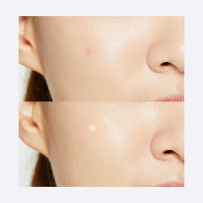 COSRX - Acne Pimple Master Patch